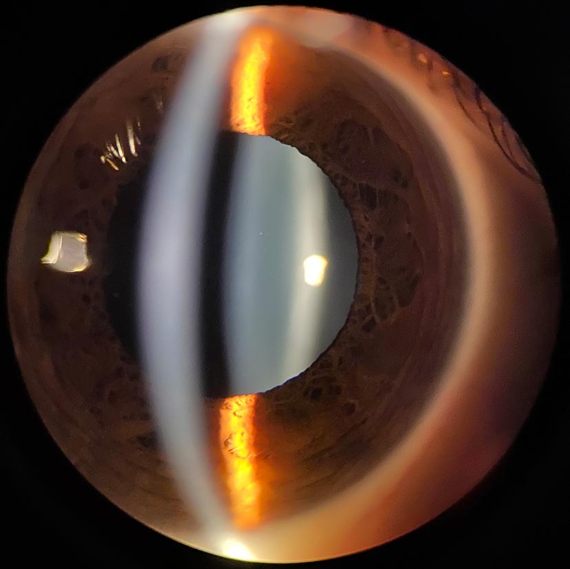 Clear Lens | Copper Eye Surgery, Paradise Valley AZ